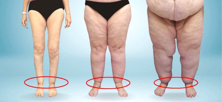 9-lipedema-awareness_